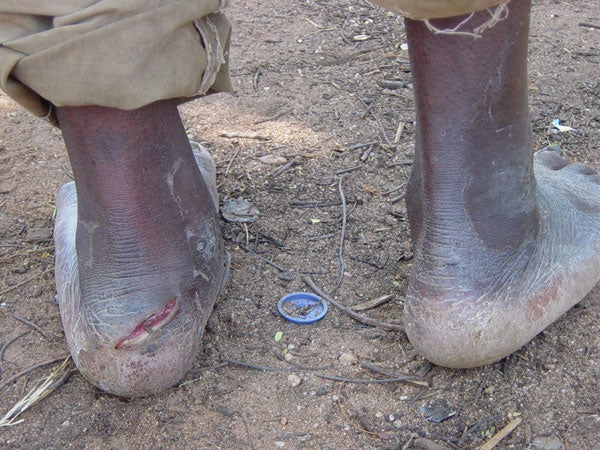 English: An FNL deserter tortured at a police post in Cibitoke province, Burundi © 2006 Human Rights Watch