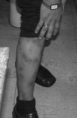 Gamal’s leg, showing scars of torture inflicted by a Damanhour Prison guard.